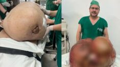 Muere mujer a la que extirparon tumor de 46 kg en Brasil, parecía que se estaba recuperando