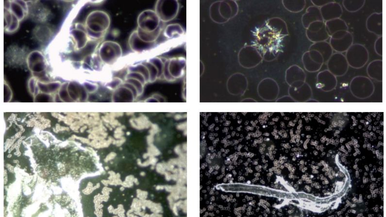 Figura 4: Estas 4 imágenes ilustran la variedad de fenómenos y objetos inusuales encontrados en la sangre de sujetos vacunados con Comirnaty (BioNTech/Pfizer). (Grupo de Trabajo Alemán para el Análisis de la Vacuna COVID (GWG))