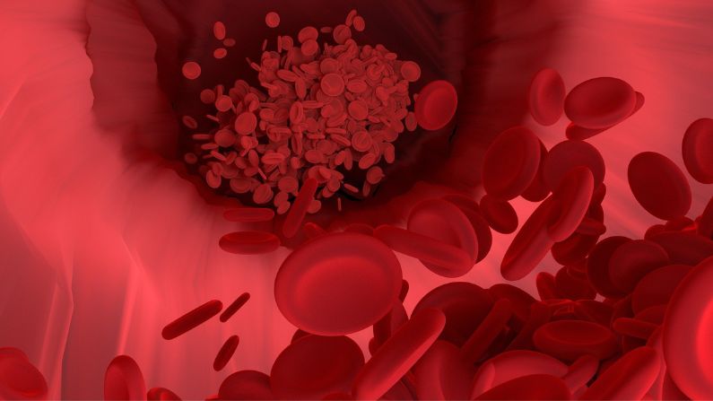 Una investigación descubrió que las tasas de incidencia tanto de la trombosis arterial como de la trombosis venosa aumentan significativamente en los pacientes de COVID. (Pixabay / Vector8DIY)