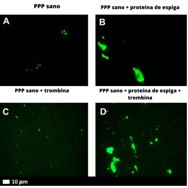 Micrografías de fluorescencia representativas de PPP de individuos sanos tras la adición de ThT (señal fluorescente verde) (A) Frotis de PPP. (B) PPP con proteína de espiga. (C) PPP con trombina para crear extensos coágulos de fibrina. (D) PPP expuesta a proteína spike seguida de la adición de trombina. La concentración final de proteína spike fue de 1 ng.ml-1. (Imagen de Grobbelaar LM, Venter C, Vlok M, Ngoepe M, Laubscher GJ, Lourens PJ, Steenkamp J, Kell DB, Pretorius E. SARS-CoV-2 spike protein S1 induces fibrin(ogen) resistant to fibrinolysis: implications for microclot formation in COVID-19.) Biosci Rep. 2021 Aug 27;41(8):BSR20210611. doi: 10.1042/BSR20210611. )