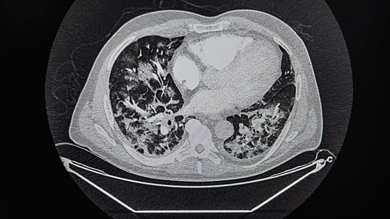 Un escáner muestra los pulmones de paciente infectado con COVID-19 en la unidad de cuidados intensivos del hospital Franco-Británico de Levallois-Perret, al norte de París, el 9 de abril de 2020, las zonas negras corresponden al estado "normal" de los pulmones, ya que las manchas blancas son causadas por el virus.  (LUCAS BARIOULET/AFP vía Getty Images)