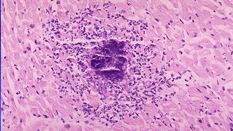 (Imagen microscópica de una Miocarditis. Wikipedia / LizetPath)