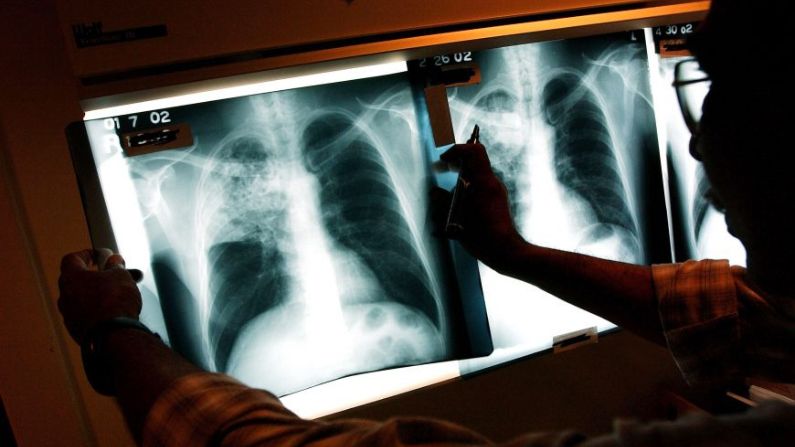 Un médico examina las radiografías de un paciente con tuberculosis en una clínica de Brooklyn, Nueva York, el 27 de noviembre de 2002. (Spencer Platt/Getty Images)