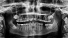 Dentistas: Dolor inexplicable, caída de dientes y problemas óseos podrían vincularse a vacuna para COVID
