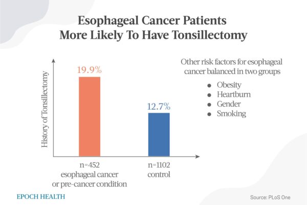 Los pacientes con cáncer de esófago tenían más probabilidades de haberse sometido a una amigdalectomía. (The Epoch Times)