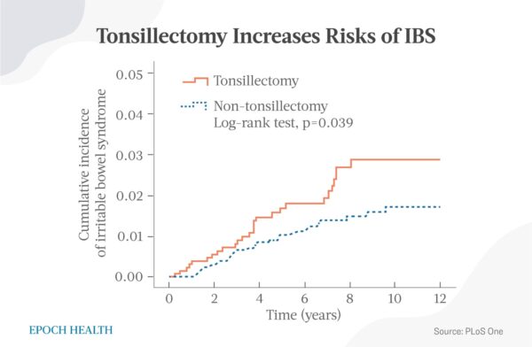 La amigdalectomía aumenta el riesgo de síndrome del intestino irritable. (The Epoch Times)