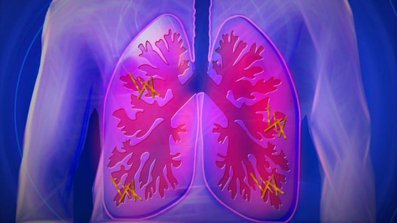 Imagen editada por The Epoch Times. Ilustración de pulmones. (Pixabay/ kalhh; Inserción: Pixabay/ Breaking_Brain)