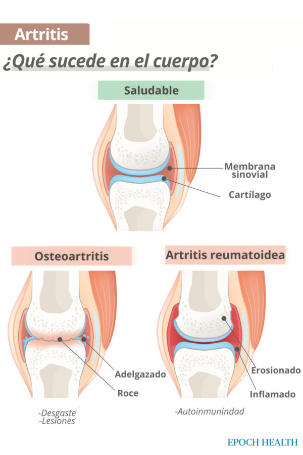 La artrosis y la artritis reumatoide son los dos tipos principales de artritis. (The Epoch Times)