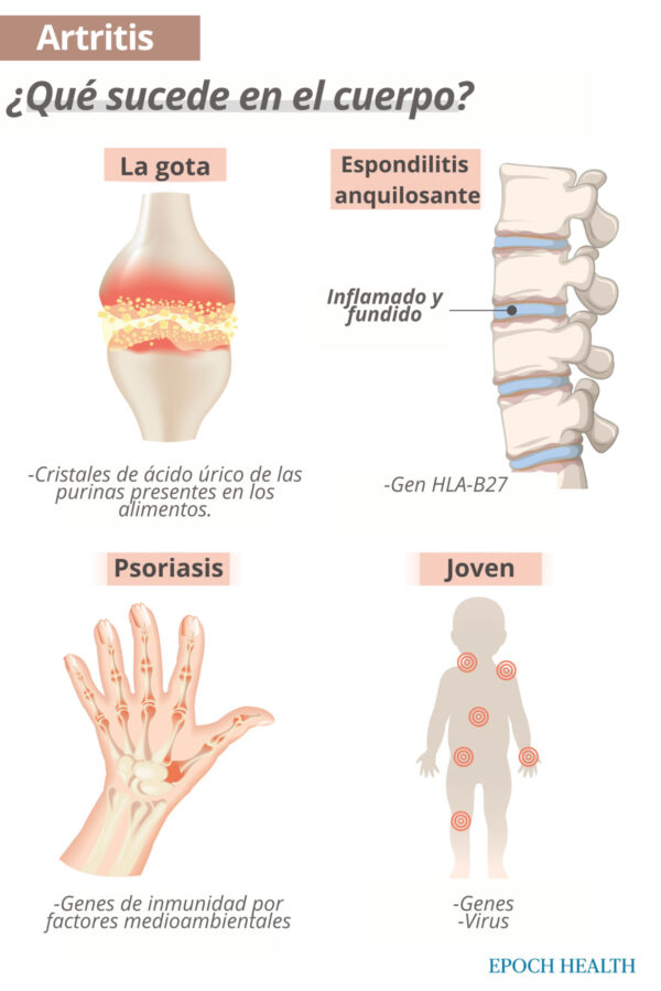 La gota, la espondilitis anquilosante, la artritis juvenil y la artritis psoriásica son sólo algunos de los muchos tipos de artritis. (The Epoch Times)