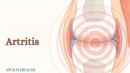 La Guía Esencial de la Artritis: Síntomas, causas, tratamientos y enfoques naturales