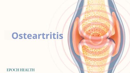 La guía esencial para la osteoartritis: síntomas, causas, tratamientos y enfoques naturales