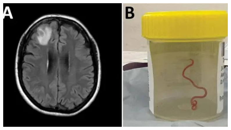 (A) Resonancia magnética del cerebro de la paciente, (B) gusano extraído del lóbulo frontal derecho de la paciente, (Servicios de Salud de Canberra/Centros para el Control y la Prevención de Enfermedades)