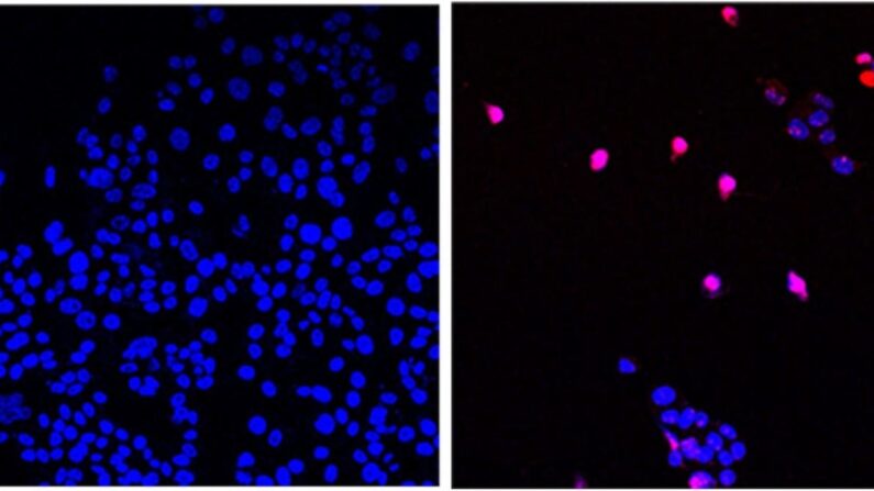 La pequeña molécula AOH1996 desarrollada por City of Hope se dirige a una variante cancerosa de la proteína PCNA. En su forma mutada, la PCNA es fundamental en la replicación y reparación del ADN de todos los tumores en expansión. La imagen muestra células cancerosas no tratadas (Izq) y células cancerosas tratadas con AOH1996 (Der) que experimentan muerte celular programada (violeta). (Cortesía de City of Hope)