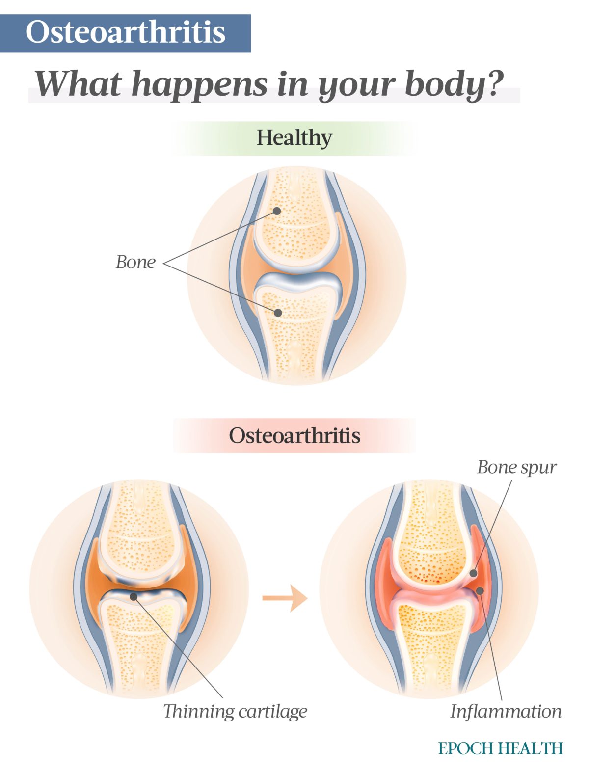 En la osteoartritis primaria, una sobreproducción de enzimas desencadena el deterioro del cartílago y la inflamación y, finalmente, los espolones óseos. (The Epoch Times)