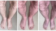 Decoloración violácea de las piernas: Un síntoma inusual de COVID persistente