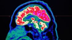 Científicos hallan un nuevo método para detectar indicadores precoces de esquizofrenia