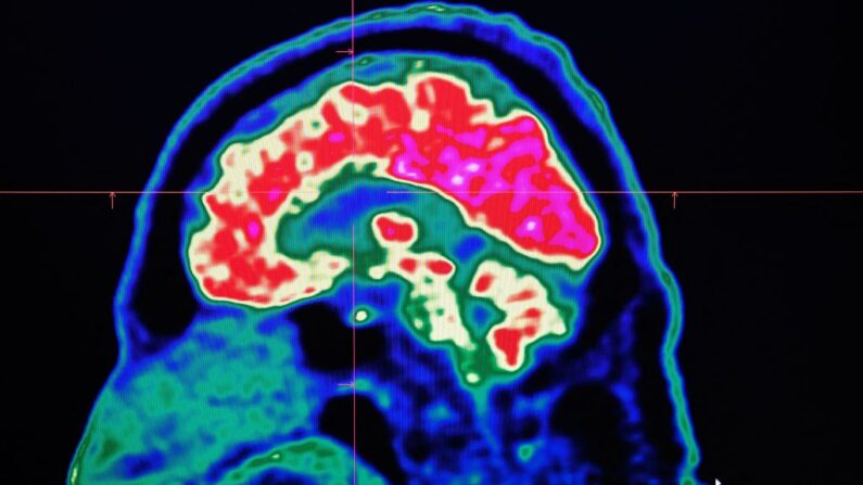 Una imagen de un cerebro humano tomada por un escáner de tomografía. (Fred Tanneau/AFP vía Getty Images)