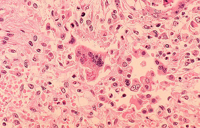 En esta imagen de microscopio de 1972 de los Centros para el Control y la Prevención de Enfermedades (CDC), se ve una histopatología de una neumonía causada por sarampión. (Los CDC a través de Getty Images)