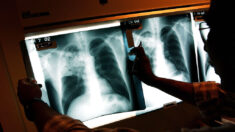 La tuberculosis supera al COVID-19 como enfermedad infecciosa más mortífera