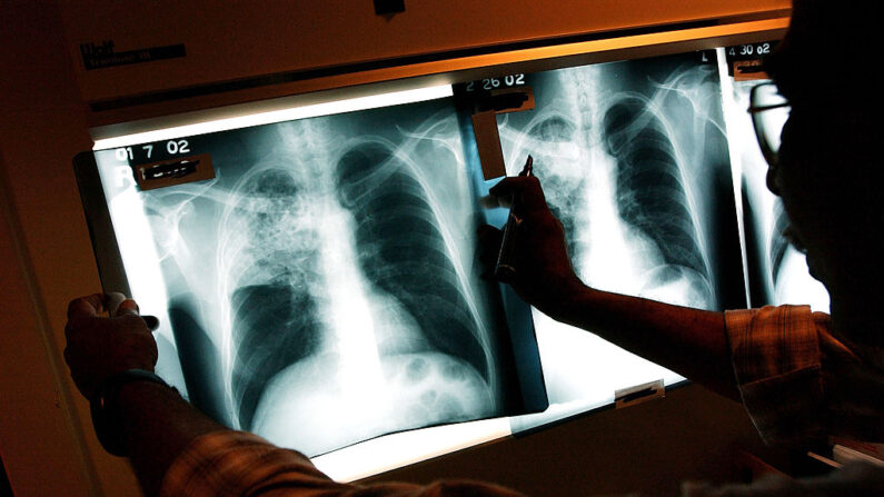 Un médico examina las radiografías de un paciente con tuberculosis (TB) en una clínica de tuberculosis el 27 de noviembre de 2002 en Brooklyn, Nueva York. (Spencer Platt/Getty Images)