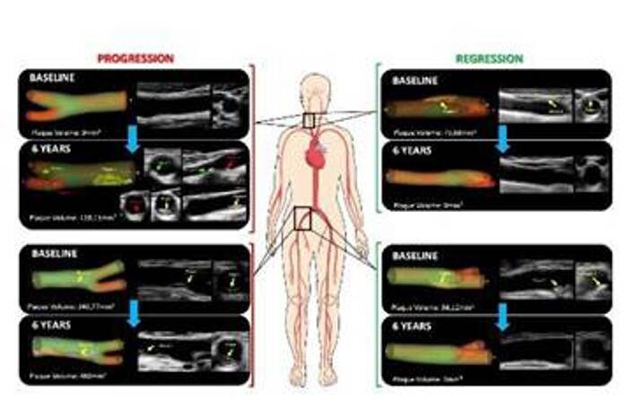 En la imagen se observan casos de progresión de aterosclerosis (Izq.) y de regresión (desaparición de la misma, Der.) en arterias carótidas (en el cuello) en las femorales (ingles). (EFE/Imagen cedida por el Centro Nacional de Investigaciones Cardiovasculares (CNIC))