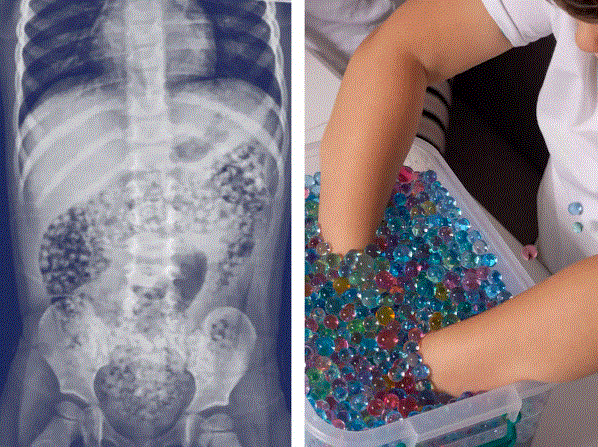 (L) Radiografía sin fecha que muestra perlas de agua expandidas dentro del cuerpo de un niño; (R) foto sin fecha de un niño jugando con una fuente de perlas de agua. (CPSC)