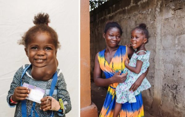 Umu antes y después de la operación con su madre, Yei. (SWNS)