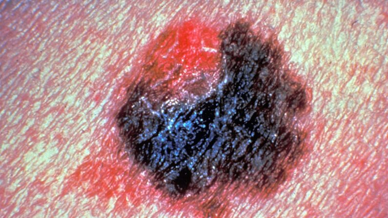 Detalle de una persona con un melanoma maligno, que es un tumor cutáneo maligno que afecta a las células de la piel que producen pigmento. (Foto de la Sociedad Americana del Cáncer/Getty Images)
