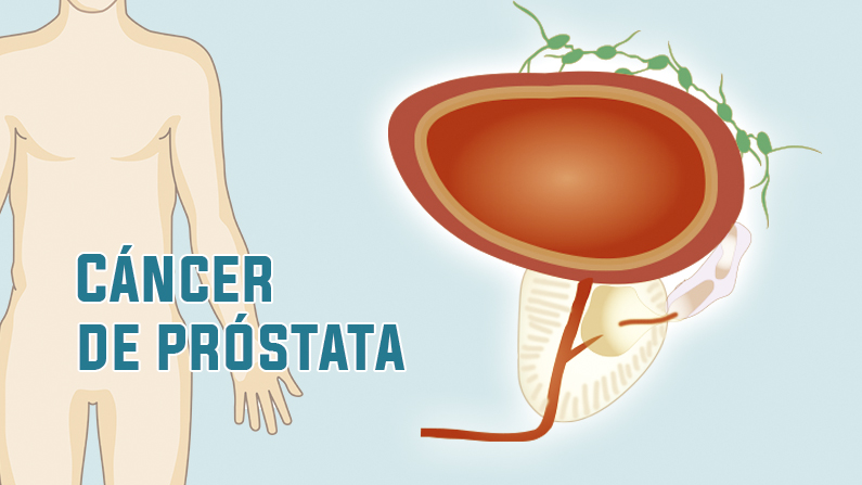 Los signos del cáncer de próstata no suelen aparecer hasta fases avanzadas. (Ilustración de The Epoch Times)