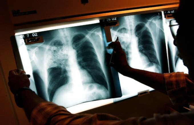 Un médico examina las radiografías de un paciente con tuberculosis en una imagen de archivo. (Spencer Platt/Getty Images)