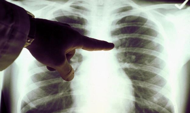 Tasas de cáncer aumentan entre los menores de 50 años en condado de California 
Primer plano de una radiografía de pulmón de un fumador en una foto sin fecha. (Sociedad Americana del Cáncer vía Getty Images)