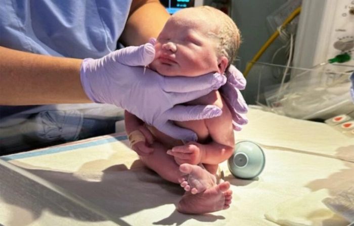 Bebé que nace sin ojos y con la mitad de su cerebro desconcierta a los médicos alcanzando sus hitos