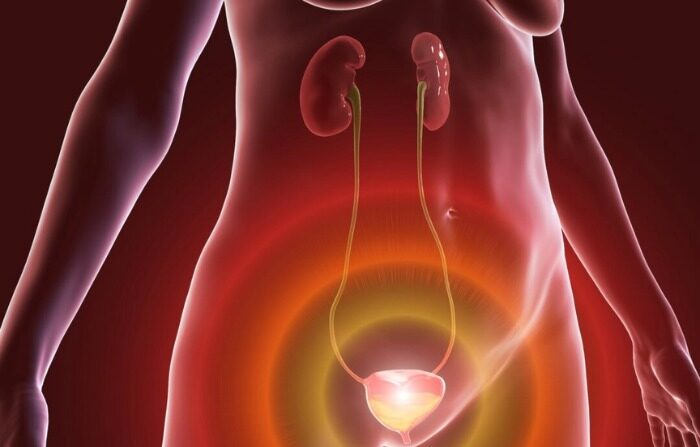 Vejiga urinaria hiperactiva en una mujer, ilustración 3D. Una condición en la que hay una sensación frecuente de necesidad de orinar, a veces con pérdida del control de la vejiga que conduce a incontinencia urgente.