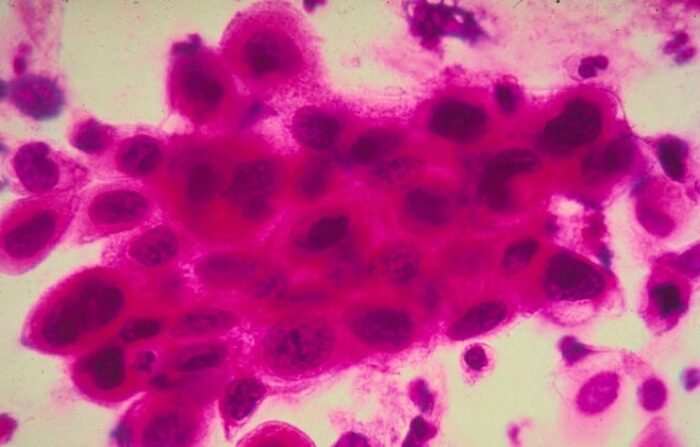 Primer plano de las células cancerosas en el cuello uterino. (Sociedad Estadounidense contra el Cáncer/Getty Images)