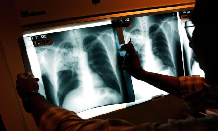 Un médico examina las radiografías de un paciente con tuberculosis en una imagen de archivo. (Spencer Platt/Getty Images)