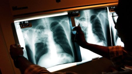 Declaran emergencia por tuberculosis en ciudad de California: Qué hay que tener en cuenta