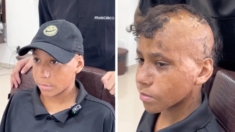 Niño de 12 años recupera su «cabello» tras años de sufrir graves quemaduras: ¡Mire cómo se ve!