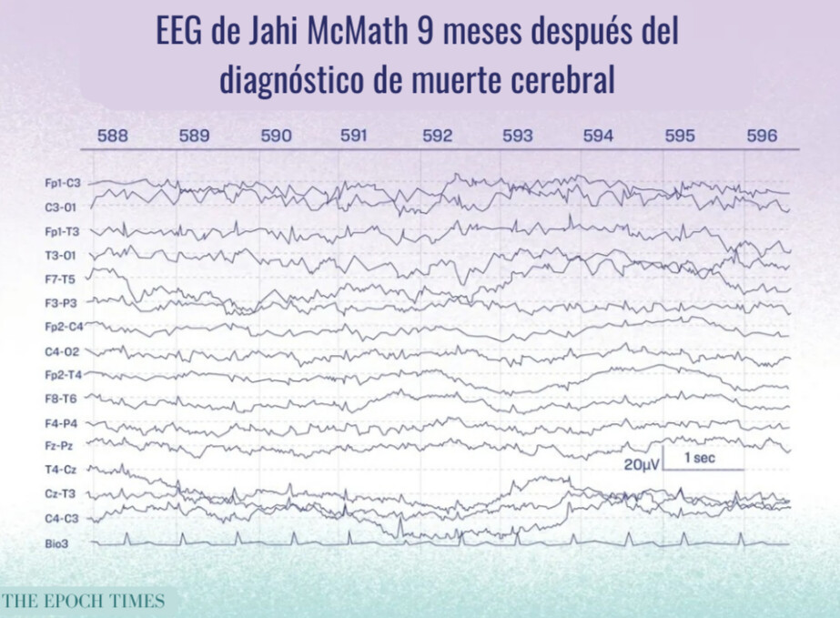 El EEG de Jahi McMath, declarado con muerte cerebral, no debería haber mostrado actividad.