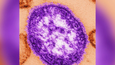Confirman casos de sarampión en Seattle y Ohio