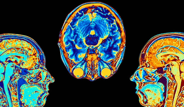 Una foto de archivo sin fecha muestra imágenes de resonancia magnética (RMN) en falso color mejoradas por computadora de las estructuras cerebrales. (Alfred Pasieka/Fototeca de Ciencia/Getty Images)