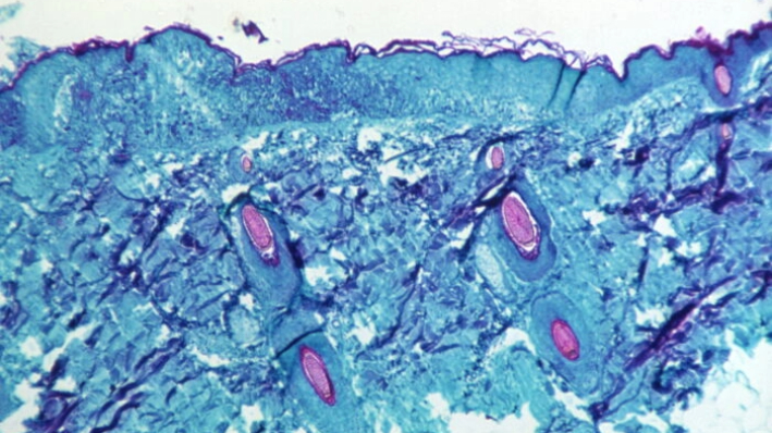 Una sección de tejido cutáneo, recogido de una lesión en la piel de un mono, que había sido infectado con el virus de la viruela del mono, se ve con una ampliación de 50X en el cuarto día de desarrollo de la erupción en 1968. (CDC/Handout vía Reuters)