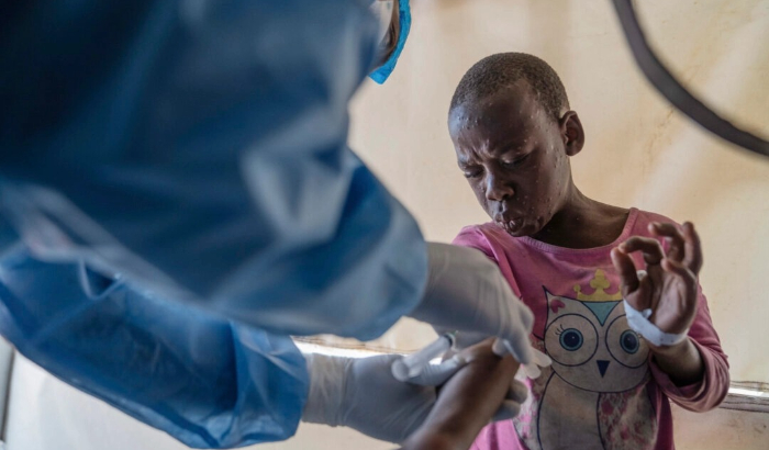 Un trabajador sanitario atiende a un paciente con viruela del mono en un centro de tratamiento en Munigi, al este del Congo, el 19 de agosto de 2024. (AP Photo/Moses Sawasawa, Archivo)