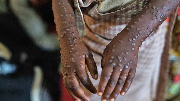 Un paciente con una forma grave de la epidemia de viruela del mono recibe tratamiento en el hospital de Kavumu, 30 km al norte de Bukavu, en el este de la República Democrática del Congo, 24 de agosto de 2024.(GLODY MURHABAZI/AFP vía Getty Images)