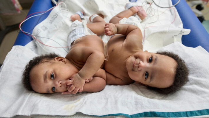 Gemelos que nacieron unidos celebran su primer cumpleaños tras ser separados exitosamente