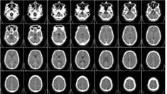 Uno de cada cuatro pacientes «inconscientes» en realidad podría estar consciente, sugiere estudio