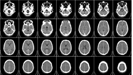 Uno de cada cuatro pacientes «inconscientes» en realidad podría estar consciente, sugiere estudio