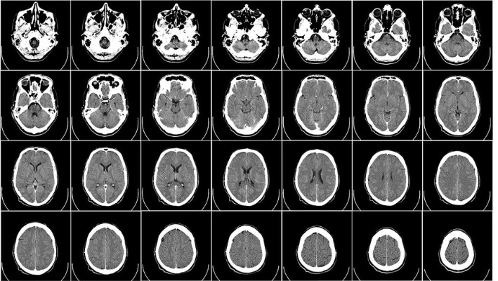 Uno de cada cuatro pacientes «inconscientes» en realidad podría estar consciente, sugiere estudio