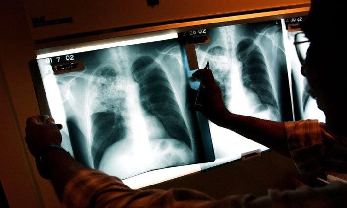 Un médico examina las radiografías de un paciente con tuberculosis en una clínica de Brooklyn, Nueva York, el 27 de noviembre de 2002. (Spencer Platt/Getty Images)