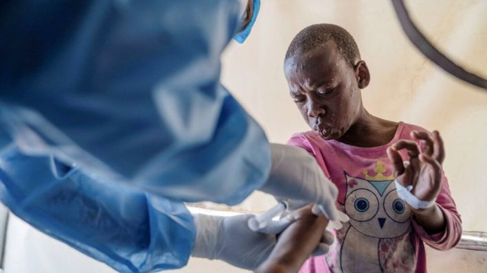 Un trabajador de la salud atiende a un paciente con viruela en un centro de tratamiento en Munigi, al este del Congo, el 19 de agosto de 2024. (Moses Sawasawa/AP Photo)