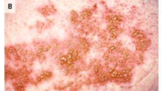 La Guía Esencial del Herpes Zóster: Síntomas, causas, tratamientos y enfoques naturales